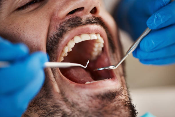 Best Emergency Wisdom Teeth Removal in Greenvle, IL